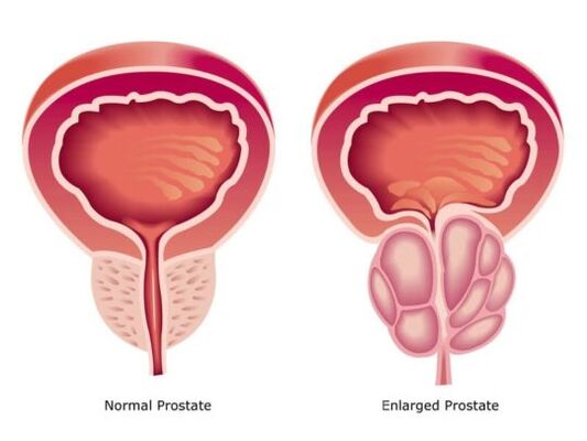 Normale en vergrote prostaat