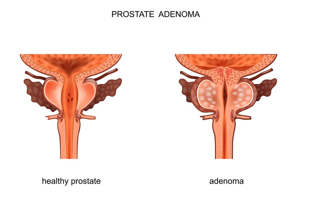 gezonde prostaat en met adenoom